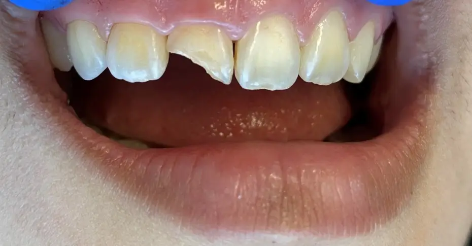 filling-2